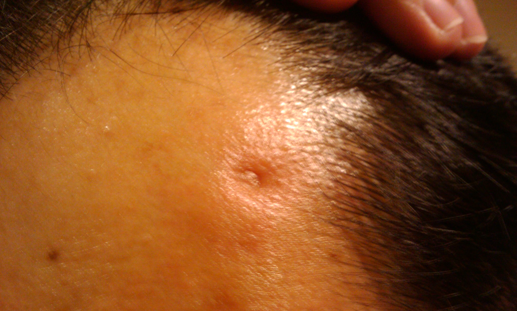 NIRS probe leaves a dent on head NIRS probe leaves a dent on head